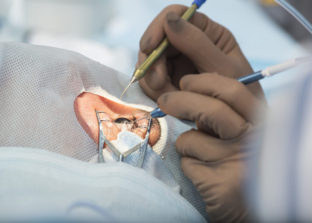 Cataract Eye Surgery