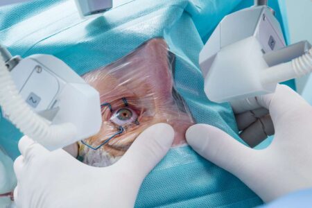 Cataract Eye Surgery